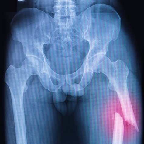 Audio atmosfir pengobatan tradisional patah tulang paha (Aksen Makassar)